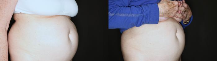 Before & After EMSCULPT NEO® Case 103 Left Oblique View in Medford, Oregon