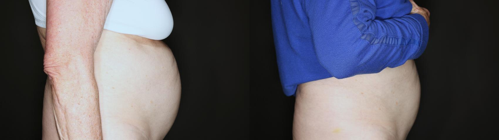 Before & After EMSCULPT NEO® Case 103 Left Side View in Medford, Oregon