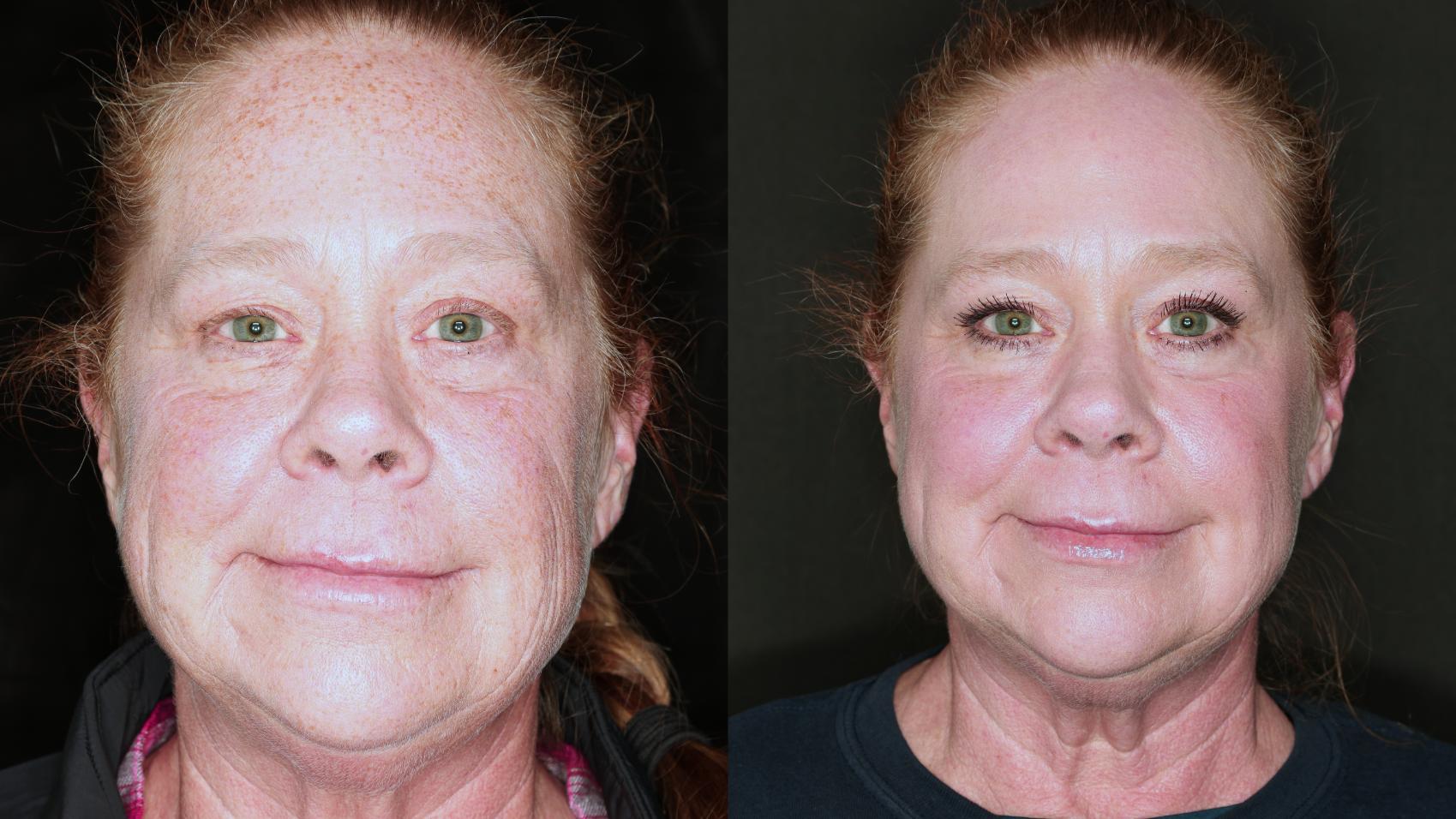 Before & After HALO® Laser Skin Rejuvenation Case 89 Front View in Medford, Oregon