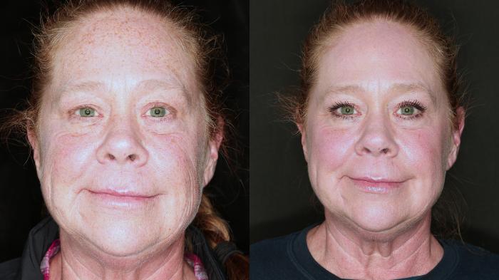 Before & After HALO® Laser Skin Rejuvenation Case 89 Front View in Medford, Oregon