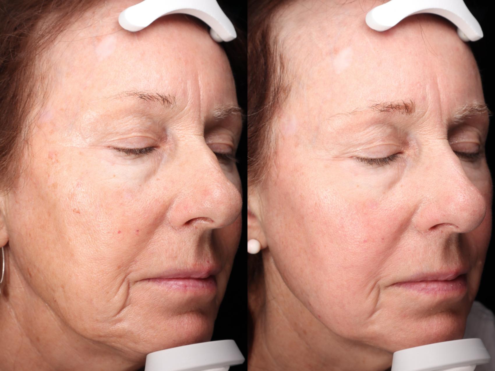 Before and after photos for 3 Halo Treatments