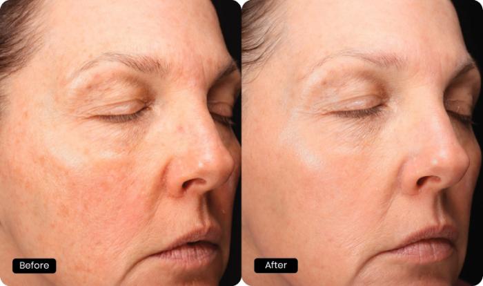 Before & After HALO® TRIBRID™ by Sciton Case 91 Right Oblique View in Medford, Oregon