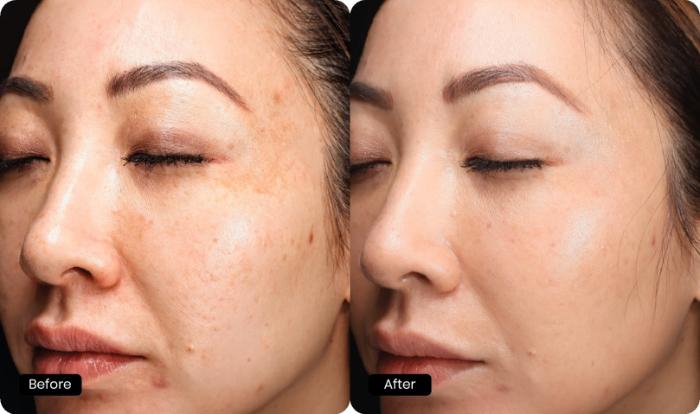 Before & After HALO® TRIBRID™ by Sciton Case 92 Left Oblique View in Medford, Oregon