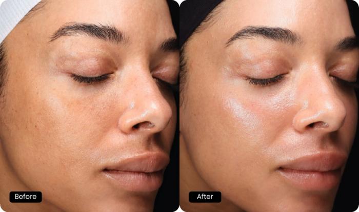 Before & After HALO® TRIBRID™ by Sciton Case 93 Right Oblique View in Medford, Oregon