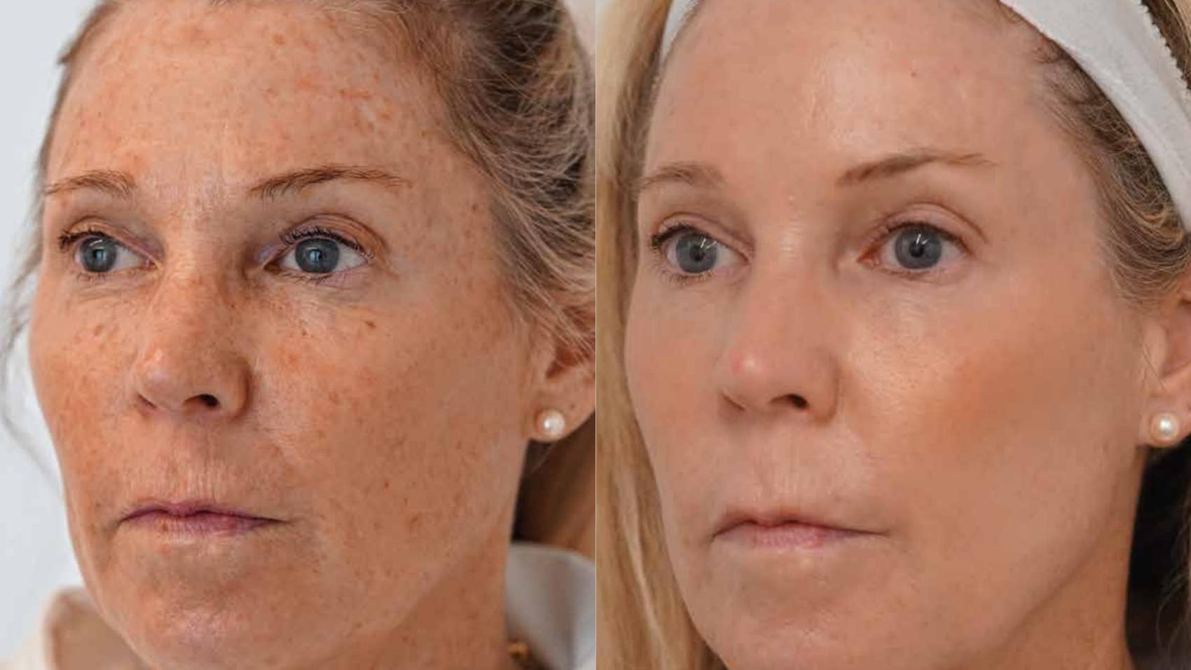 Before & After HALO® TRIBRID™ by Sciton Case 94 Left Side View in Medford, Oregon