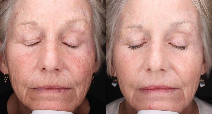 Before & After HALO® TRIBRID™ by Sciton Case 95 Left Side View in Medford, Oregon