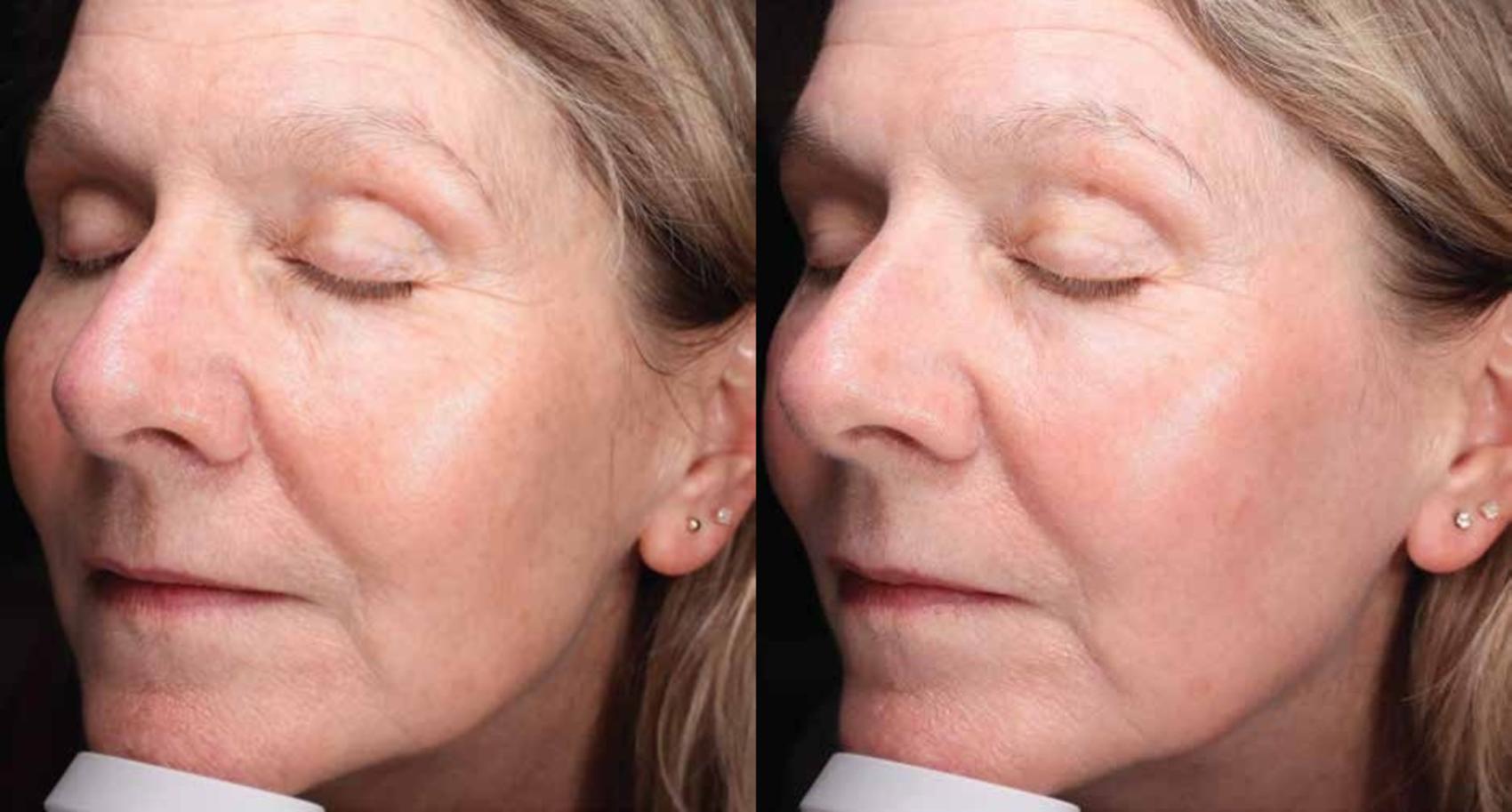 Before & After HALO® TRIBRID™ by Sciton Case 96 Left Oblique View in Medford, Oregon