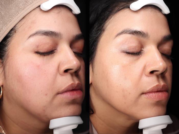 Before & After HydraFacial® Case 82 Right Side View in Medford, Oregon