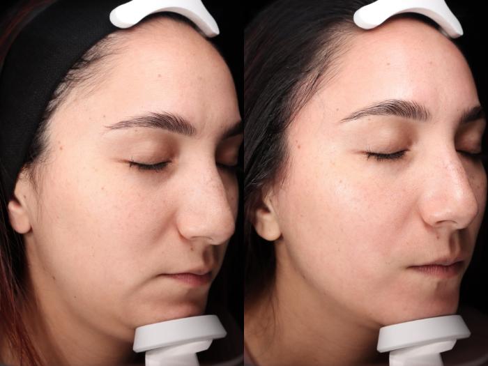 Before & After HydraFacial® Case 83 Right Side View in Medford, Oregon