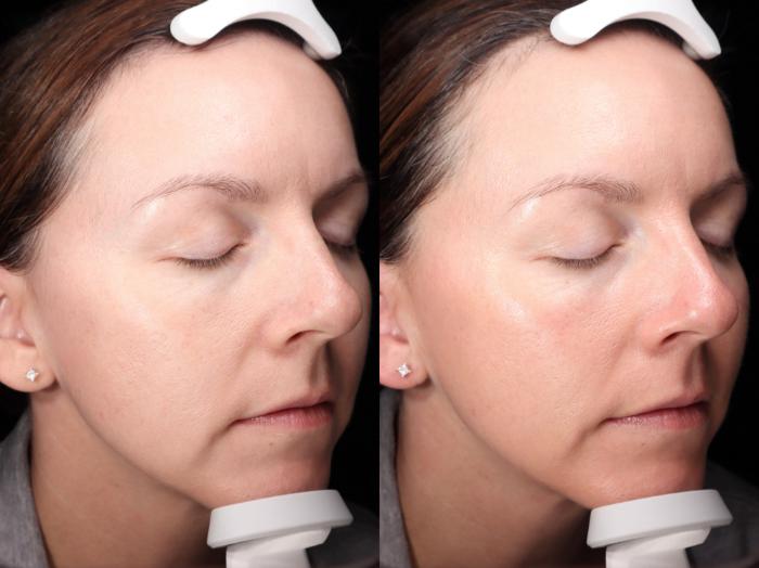 Before & After HydraFacial® Case 86 Right Side View in Medford, Oregon
