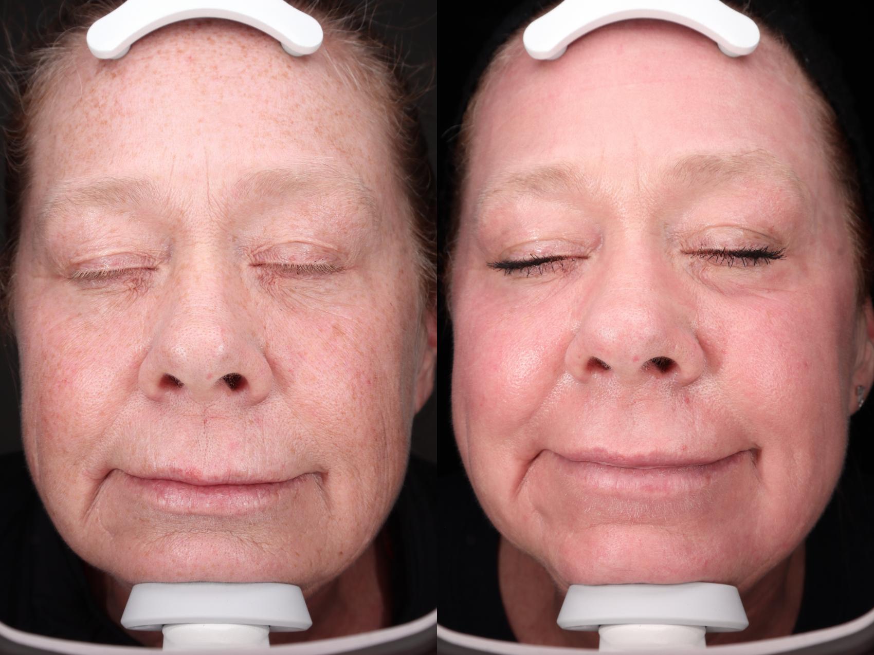 Before & After Laser Skin Rejuvenation Case 53 Front View in Medford, Oregon