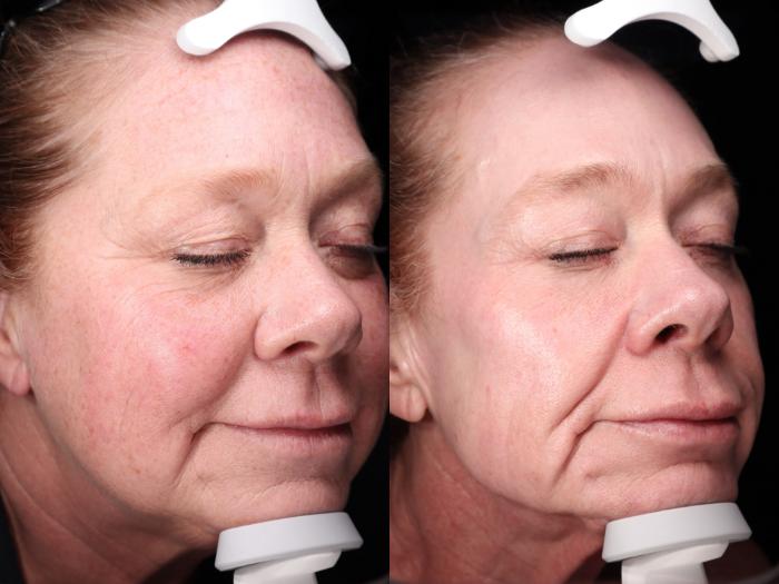 Before & After Metabolic Makeover Package Case 104 Right Side View in Medford, OR