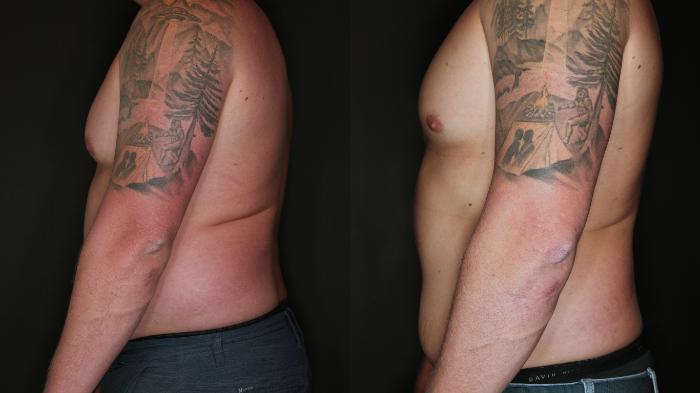 Before & After Metabolic Makeover Package Case 105 Left Side View in Medford, OR