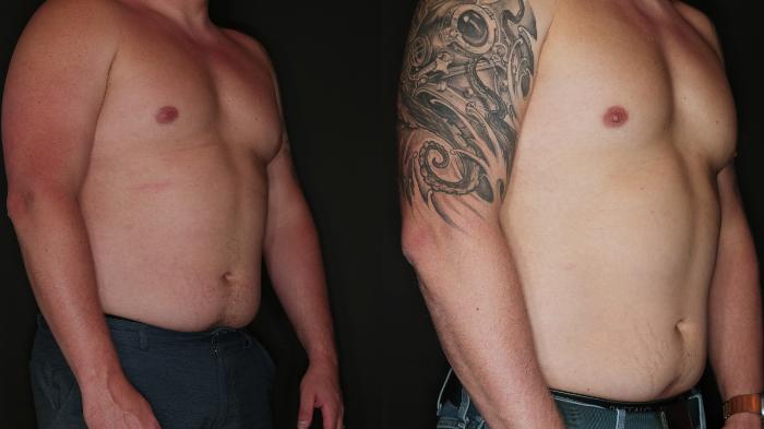 Before & After Metabolic Makeover Package Case 105 Right Side View in Medford, OR