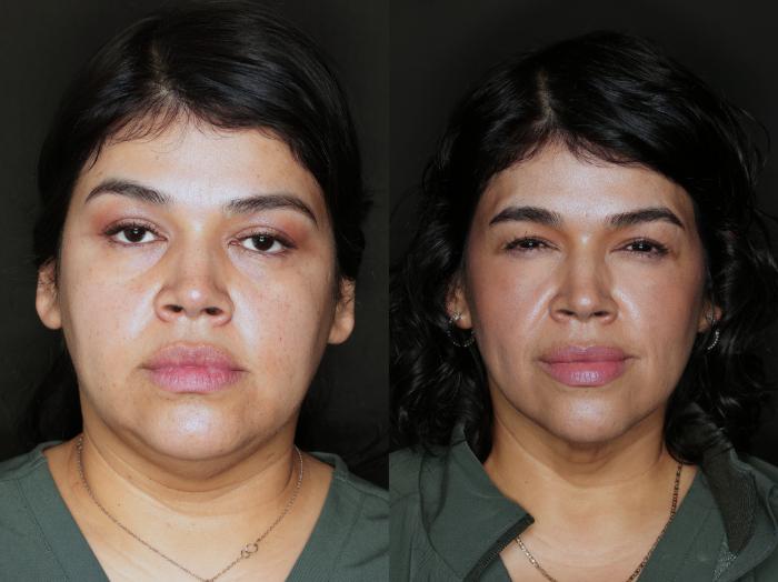 Before & After Metabolic Makeover Package Case 110 Front View in Medford, OR