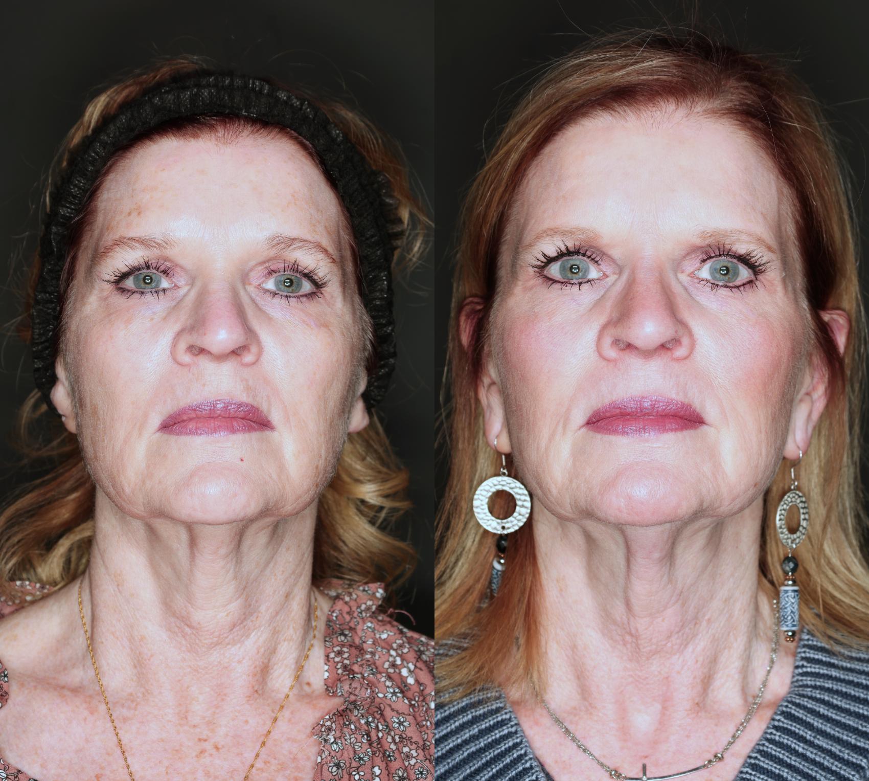 3 treatments of Nouvaderm before and after