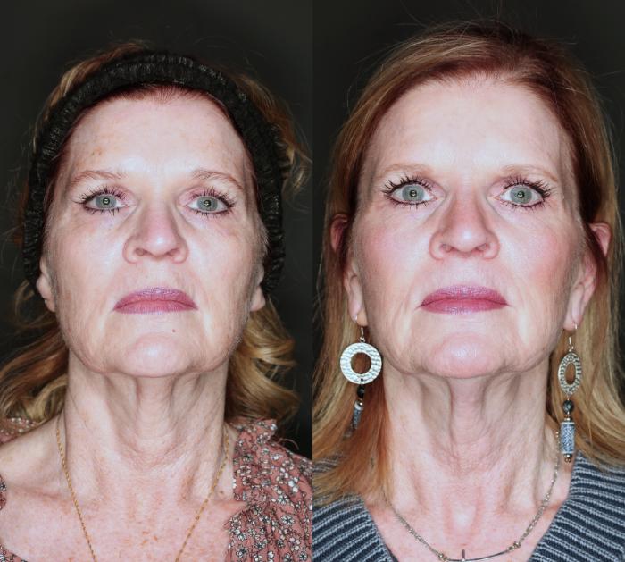 3 treatments of Nouvaderm before and after
