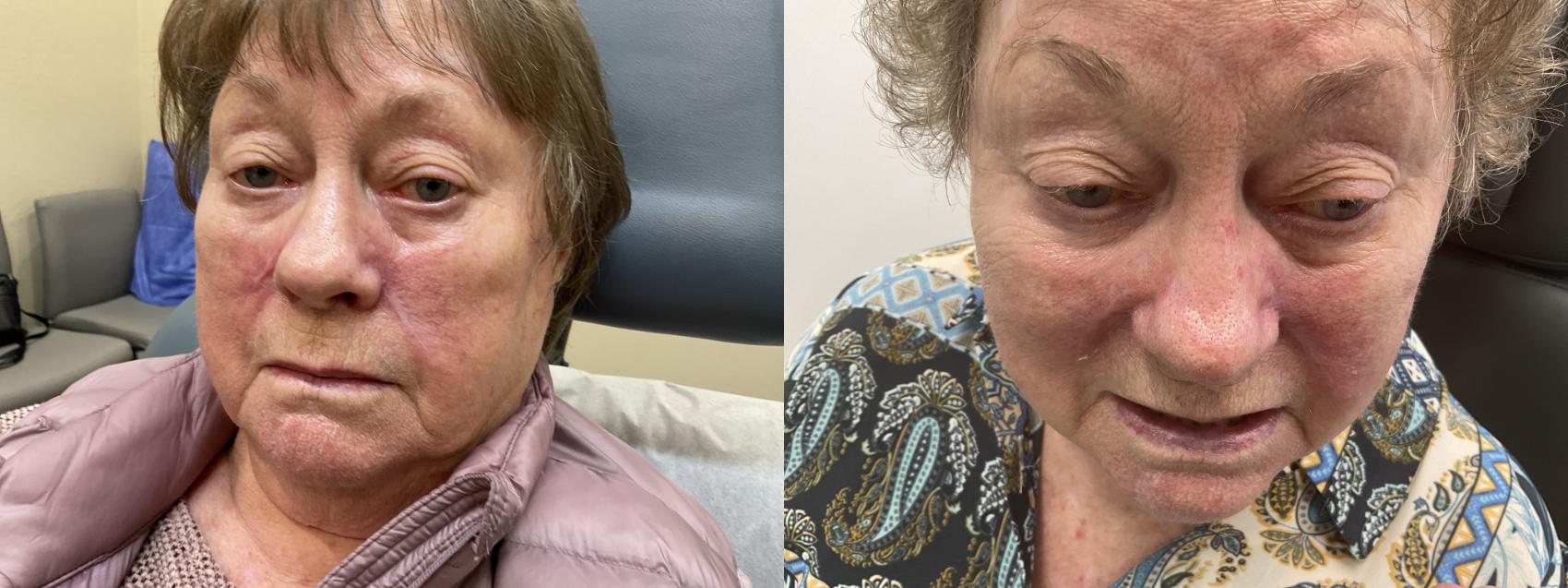 Before & After Scar Revision With Sciton ProFractional® Laser Case 52 Front View in Medford, Oregon