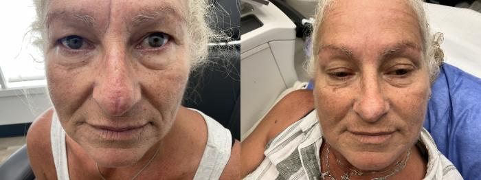 Before & After Scar Revision With Sciton ProFractional® Laser Case 56 Front View in Medford, Oregon