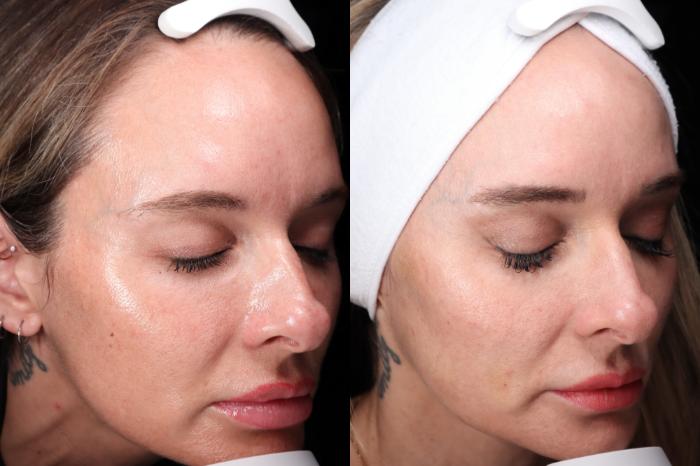 Before & After HALO® Laser Skin Rejuvenation Case 107 Right Side View in Medford, OR